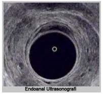 Endoanal Ultrasonografi