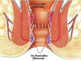 İç (İnternal) Hemoroid Anal Kanal ve Hemoroidal Damarlar